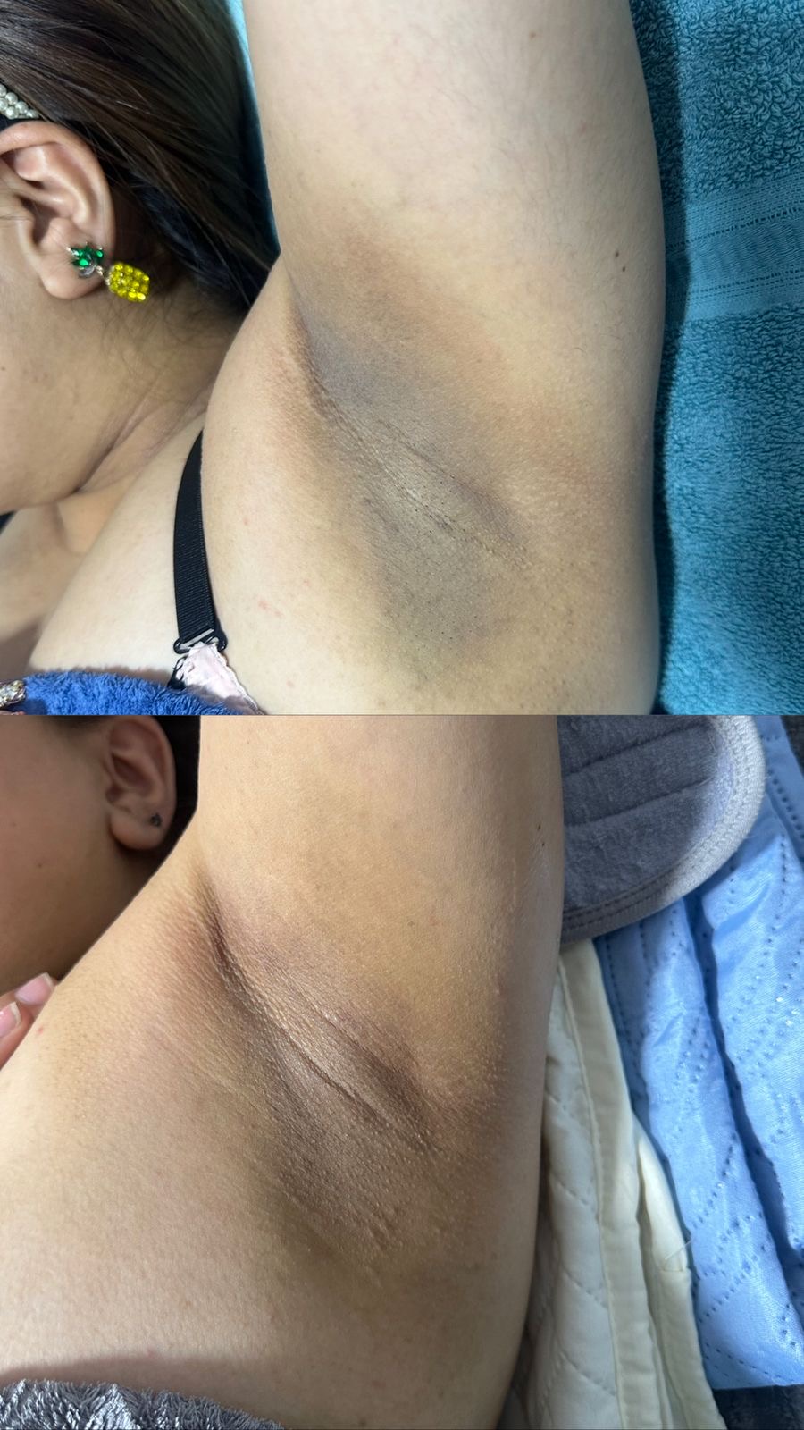 Antes y después de despigmentación de axilas